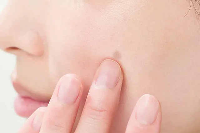 Fractional Laser