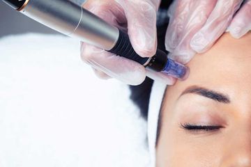 Microneedling